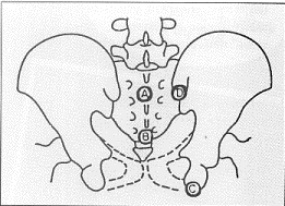 Figure Figure 3-Traitement chirurgical des lésions sacro-iliaques