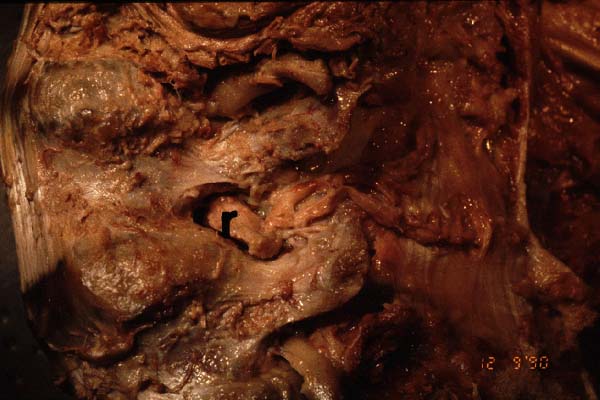 dorsal ramus